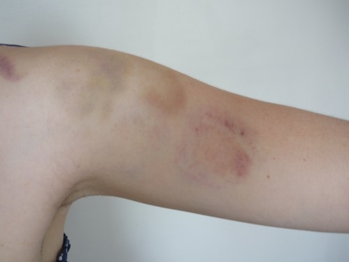 bruise